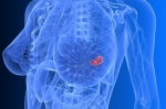 Breast-cancer-revelation-other-hormone-receptors-could-be-targeted-for-novel-therapies